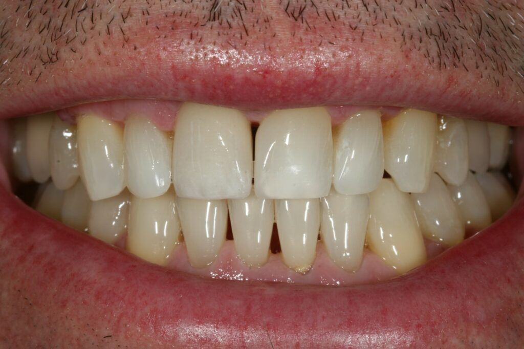 Porcelain dental crown, after