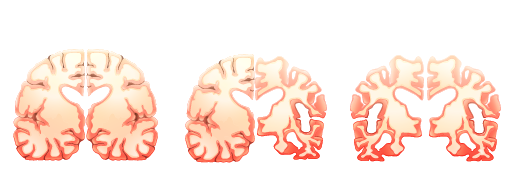 Alzheimers Progression Graphic